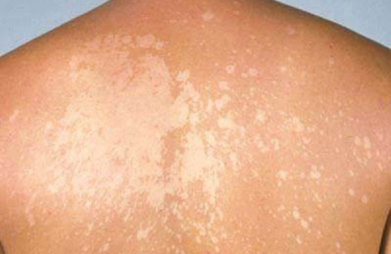 Bệnh lang ben có tự khỏi không là băn khoăn của nhiều người