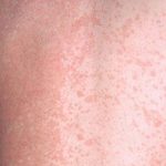 Lang ben đỏ không ảnh hưởng đến sức khỏe nhưng dễ dàng lây lan sang vùng da khác