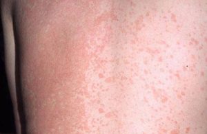 Lang ben đỏ không ảnh hưởng đến sức khỏe nhưng dễ dàng lây lan sang vùng da khác