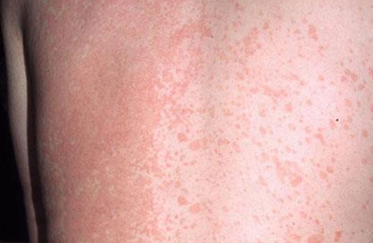 Lang ben đỏ không ảnh hưởng đến sức khỏe nhưng dễ dàng lây lan sang vùng da khác