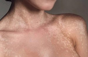 Nguyên nhân chính gây là bệnh lang ben là vi nấm Malassezia furfur (Pityrosporum ovale)