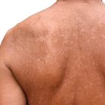 Dấu hiệu nhận biết bệnh lang ben ở lưng
