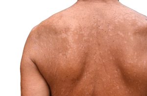 Dấu hiệu nhận biết bệnh lang ben ở lưng