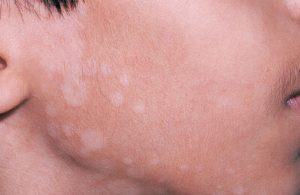 Lang ben ở mặt là một dạng nhiễm nấm da do nấm men Malassezia gây ra