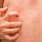 Mẩn ngứa là tình trạng da bị kích ứng, dị ứng với các chất dị nguyên