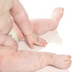Mẩn ngứa ở trẻ có nguy hiểm không?
