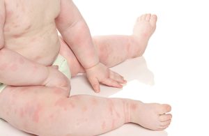 Mẩn ngứa ở trẻ có nguy hiểm không?