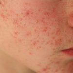 Mặt nổi mẩn đỏ không ngứa xảy ra do nhiều nguyên nhân khác nhau