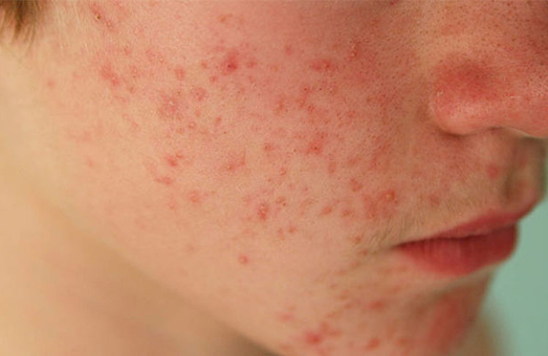Mặt nổi mẩn đỏ không ngứa xảy ra do nhiều nguyên nhân khác nhau