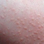Mề đay Cholinergic là một dạng mề đay vật lý thường gặp, có thể gây nổi mẩn ngứa toàn thân