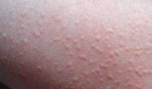 Mề đay Cholinergic là một dạng mề đay vật lý thường gặp, có thể gây nổi mẩn ngứa toàn thân