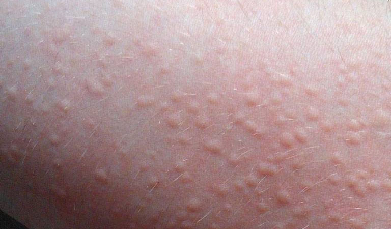 Mề đay Cholinergic là một dạng mề đay vật lý thường gặp, có thể gây nổi mẩn ngứa toàn thân