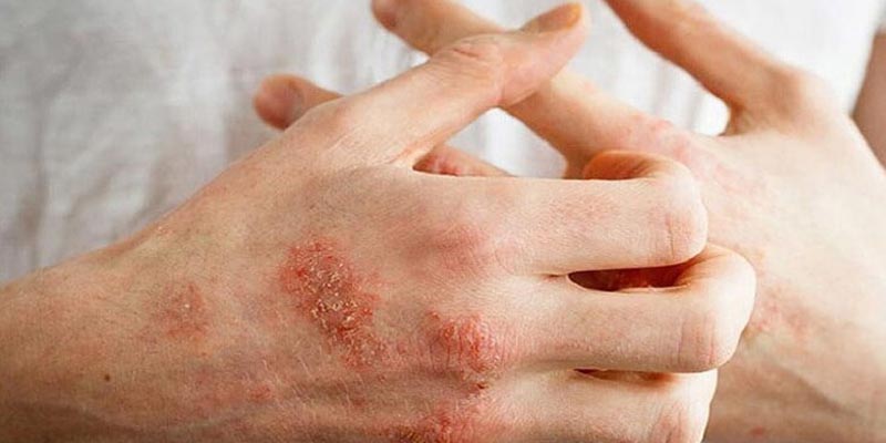 Những điều nên lưu ý khi mắc bệnh hắc lào