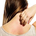 Triệu chứng của viêm da cơ địa là nổi mẩn đỏ, phát ban, viêm sưng và ngứa ngáy