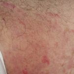 Nổi mẩn đỏ không ngứa ở háng do dị ứng tiếp xúc