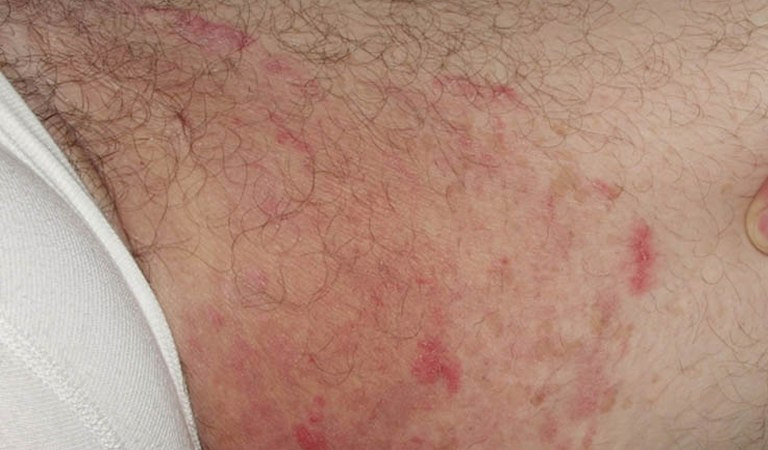 Nổi mẩn đỏ không ngứa ở háng do dị ứng tiếp xúc