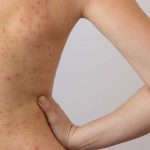 Nổi mẩn đỏ ở lưng nhưng không ngứa có thể là biểu hiện của bệnh viêm da cơ địa