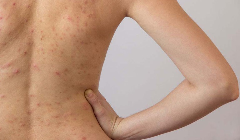 Nổi mẩn đỏ ở lưng nhưng không ngứa có thể là biểu hiện của bệnh viêm da cơ địa