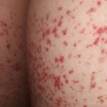 Hình ảnh tình trạng nổi mẩn đỏ ở mông nhưng không ngứa