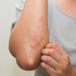 Nổi mẩn đỏ ở tay là triệu chứng bệnh viêm da cơ địa