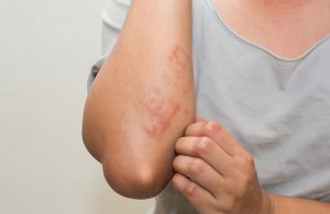 Nổi mẩn đỏ ở tay là triệu chứng bệnh viêm da cơ địa