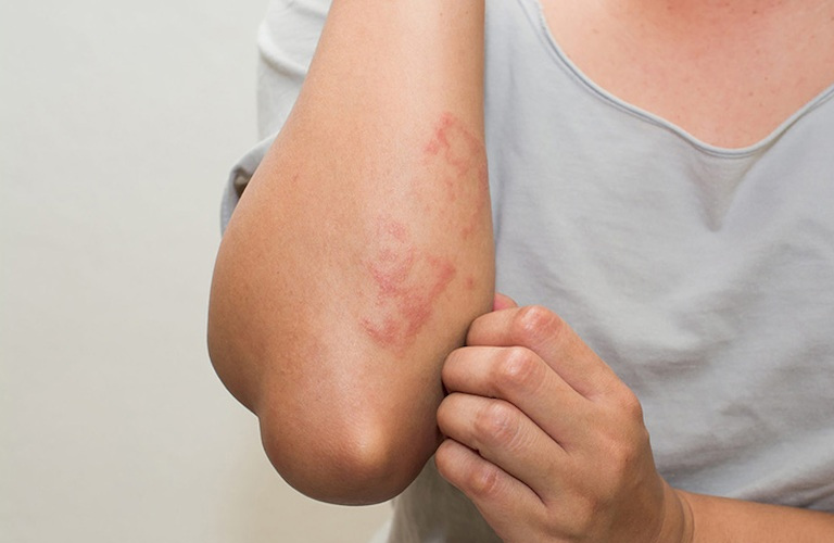 Nổi mẩn đỏ ở tay là triệu chứng bệnh viêm da cơ địa