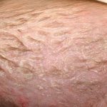 Nổi mẩn đỏ trên đầu ở trẻ em là triệu chứng của dị ứng