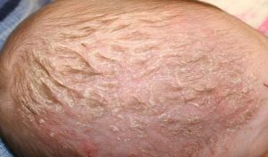Nổi mẩn đỏ trên đầu ở trẻ em là triệu chứng của dị ứng