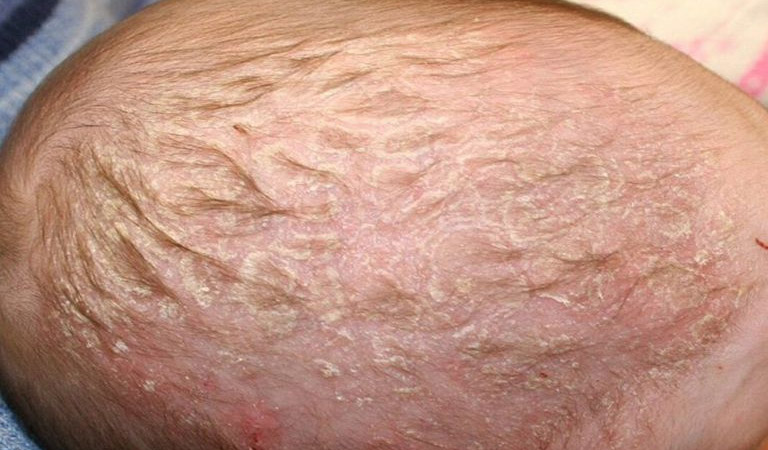 Nổi mẩn đỏ trên đầu ở trẻ em là triệu chứng của dị ứng