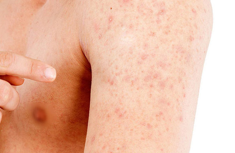 Hiện tượng nổi mẩn đỏ trên da