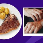Tìm hiểu nổi mề đay ăn thịt bò được không và có kế hoạch ăn uống phù hợp