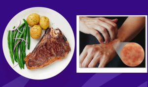 Tìm hiểu nổi mề đay ăn thịt bò được không và có kế hoạch ăn uống phù hợp