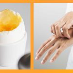 Nếu bị dị ứng với trứng, người bệnh không nên ăn trứng để tránh tình trạng mề đay trở nên nghiêm trọng hơn