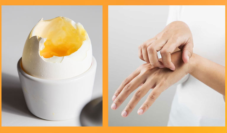 Nếu bị dị ứng với trứng, người bệnh không nên ăn trứng để tránh tình trạng mề đay trở nên nghiêm trọng hơn