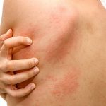 Người bị nổi mề đay không cần phải kiêng tiếp xúc với nước hoàn toàn