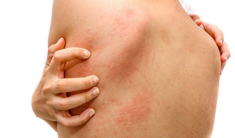 Người bị nổi mề đay không cần phải kiêng tiếp xúc với nước hoàn toàn
