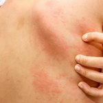 Nổi mề đay là bệnh lý xảy ra khá phổ biến khiến người bệnh cảm thấy rất ngứa ngáy, khó chịu