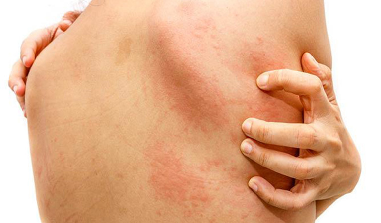 Nổi mề đay là bệnh lý xảy ra khá phổ biến khiến người bệnh cảm thấy rất ngứa ngáy, khó chịu