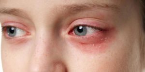 Nguyên nhân nào gây nổi mề đay quanh mắt?