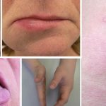 Nổi mề đay sưng môi là tình trạng phổ biến, cần được chẩn đoán và xử lý phù hợp để đảm bảo sức khỏe
