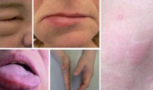 Nổi mề đay sưng môi là tình trạng phổ biến, cần được chẩn đoán và xử lý phù hợp để đảm bảo sức khỏe