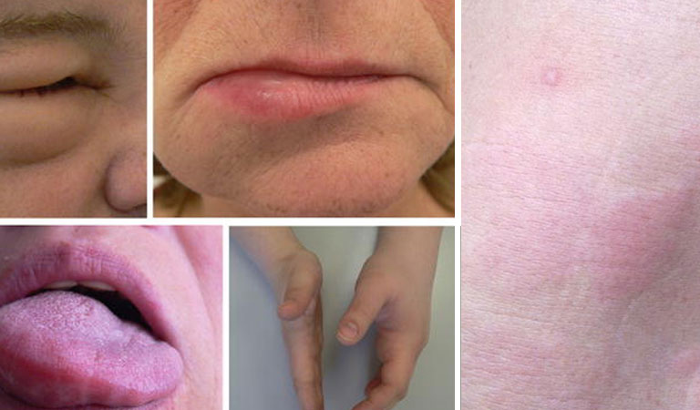 Nổi mề đay sưng môi là tình trạng phổ biến, cần được chẩn đoán và xử lý phù hợp để đảm bảo sức khỏe