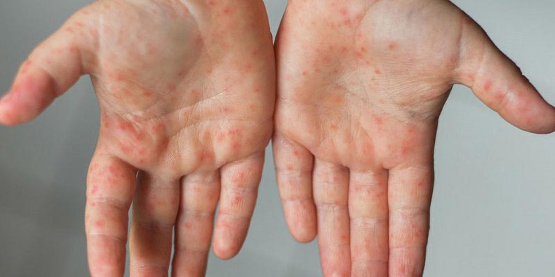 Nổi mụn nước ở tay gây ngứa là gì?