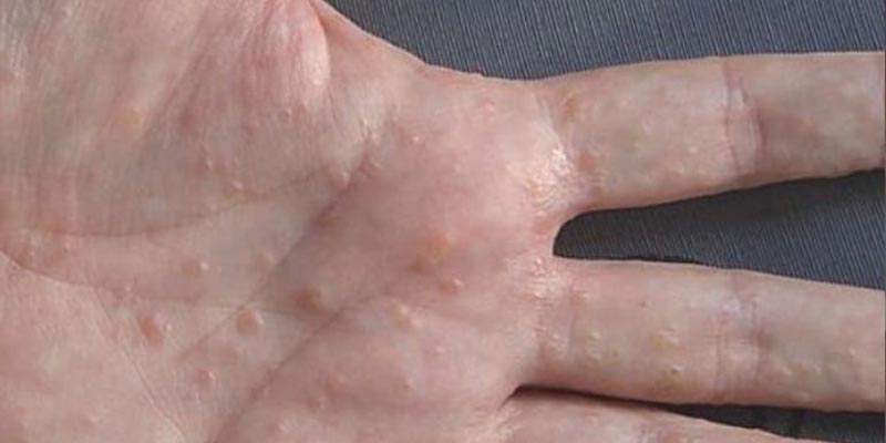 Lòng bàn tay bị ngứa nổi hột là bệnh gì?