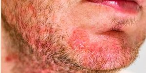 Viêm nang lông là gì? Mụn trứng cá là gì?