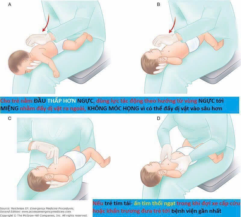 Hóc dị vật hoàn toàn có thể phòng tránh và xử trí hiệu quả nếu người chăm sóc trẻ nhận biết đúng dấu hiệu, thực hiện sơ cứu cũng như đưa đến cơ sở y tế kịp thời.