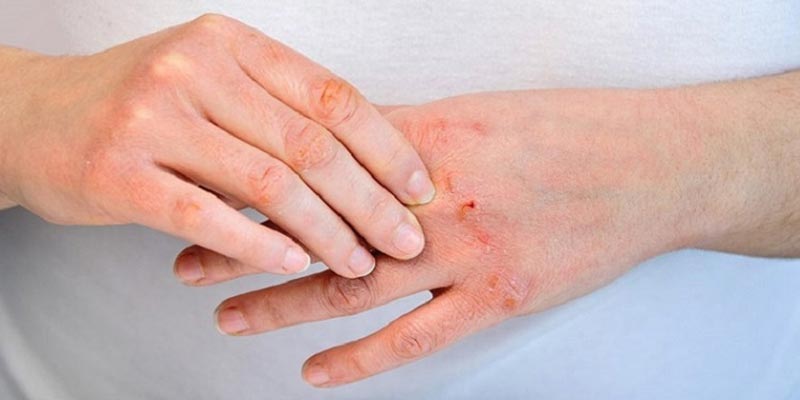 Bệnh viêm da cơ địa có lây không?