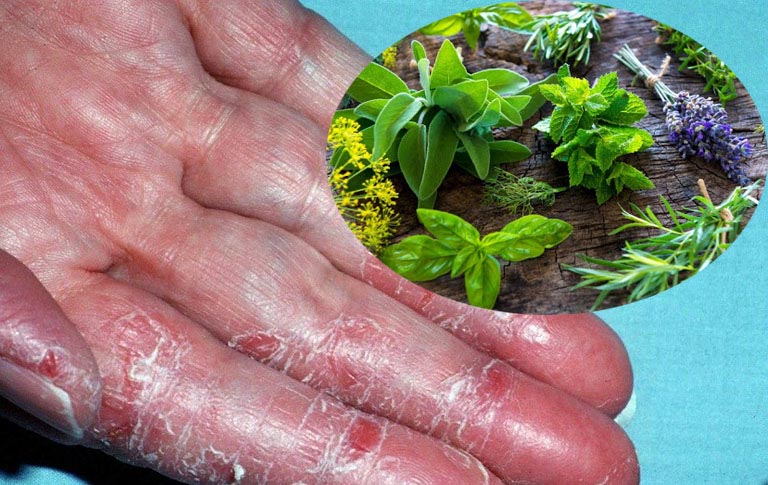 Có thể kết hợp điều trị y tế với áp dụng các bài thuốc nam chữa bệnh á sừng