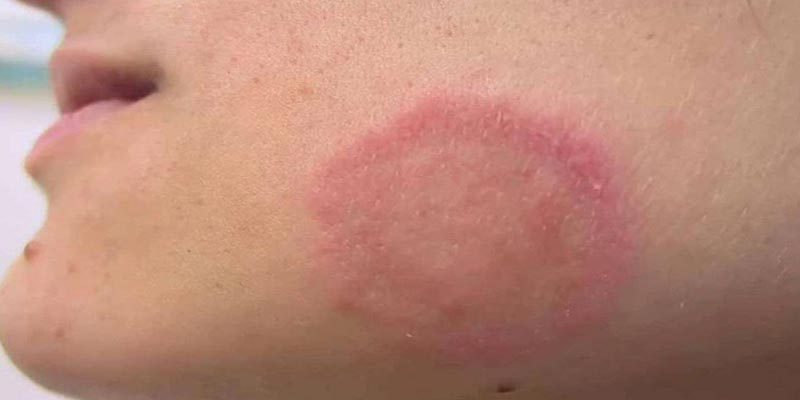 Các Loại Thuốc Trị Lang Beng Hiệu Quả