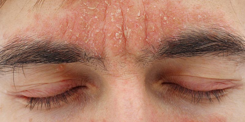Các loại thuốc trị viêm da tiết bã hiệu quả được nhiều người tin dùng